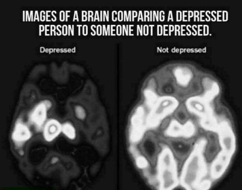 مقایسه تصویر مغز